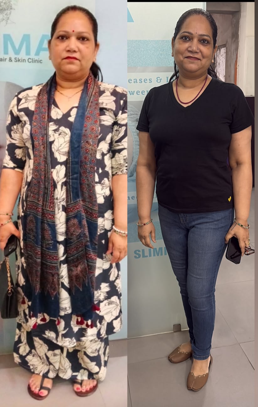 Before and after weight loss result - Case 1