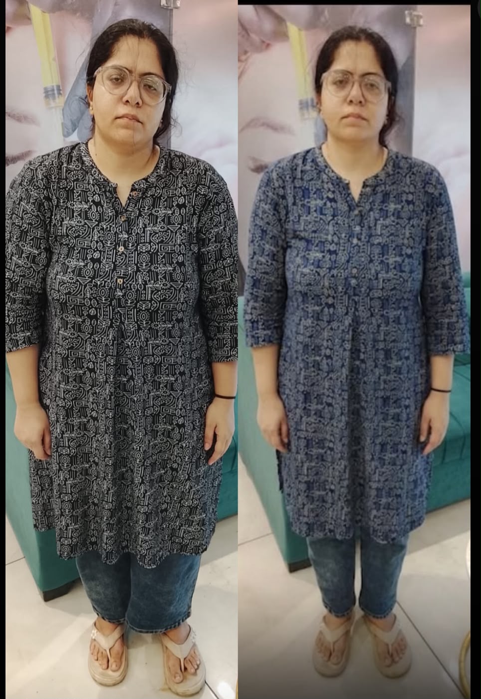 Before and after weight loss result - Case 2