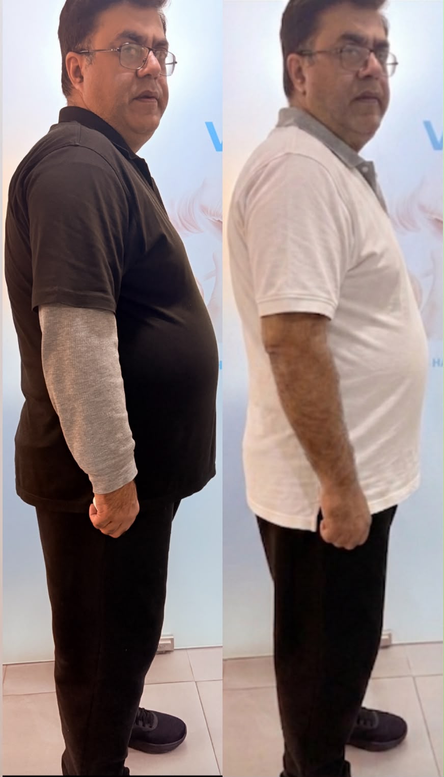 Before and after weight loss result - Case 3
